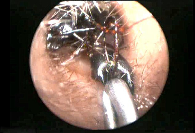 少女耳朵长满了蚂蚁!上千只蚂蚁在耳朵里啃咬