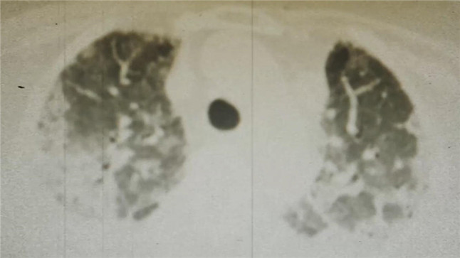 同筑健康防线丨流感超过一周还有传染性吗