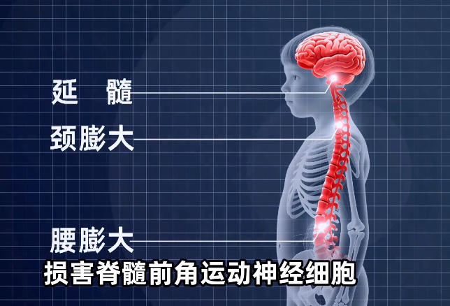 同筑健康防线丨脊髓灰质炎:吞噬无数儿童的“隐形猛兽”是如何被终结的 同筑健康防线丨脊髓灰质炎:吞噬无数儿童的“隐形猛兽”是如何被终结的