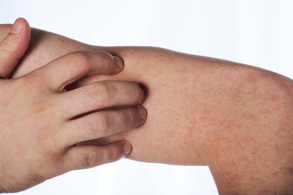 冬天得了荨麻疹该怎么办？如何快速缓解荨麻疹的症状